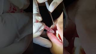 Deciduous tooth extraction [upl. by Kramal]