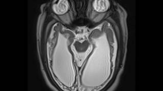 Periventricular Leukomalacia [upl. by Orlena]