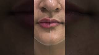 💋✨ Lip fillers skincare dermatologist skincareroutine [upl. by Tannenbaum]