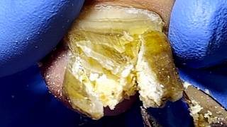 Thick Onychomycosis Completely Eliminate The Fungus【Pedicure King】 [upl. by Hadwin]