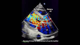 Infective Endocarditisto drahmadmirdamadisiy66XFU4h2QChqFiV [upl. by Sirad]