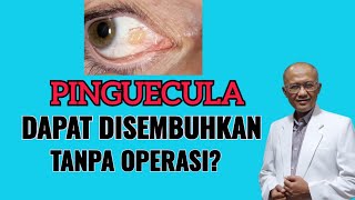 Apakah Pinguecula Bisa Disembuhkan Tanpa Operasi  dr Basuki Rokhmad SpM [upl. by Rebmac]