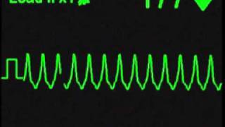 Monomorphic Ventricular Tachycardia  ECG Simulator  Arrhythmia Simulator [upl. by Hamrnand]