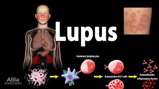 Lupus Symptoms Risk factors Pathophysiology Diagnosis and Treatments [upl. by Leyla549]