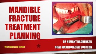 Mandible Fracture Treatment [upl. by Cross]