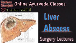 Liver abscess by Geetaru [upl. by Shriner]