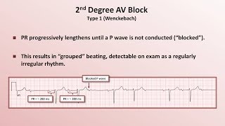 Intro to EKG Interpretation  AV Block [upl. by Gleeson]