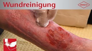 Wundreinigung Debridement bei chronischer Wunde  Verbandswechsel  DRACO [upl. by Reklaw25]