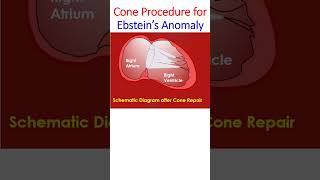 Cone Procedure for Ebstein’s Anomaly [upl. by Erdried]