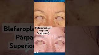 Blefaroplastia Párpados Superiores video completo➡️httpsyoutubeCodQaERaf4IsiYTGD3MarU8gAMr9H [upl. by Valaree]