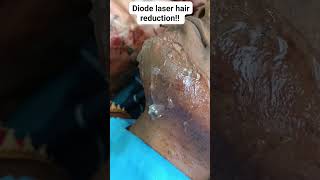 Diode laser hair reduction for removal of unwanted hair [upl. by Garneau838]