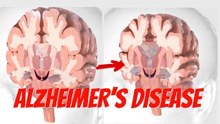 The Anatomy and Physiology of Alzheimer’s Disease Understanding the Brains Changes [upl. by Maffei]