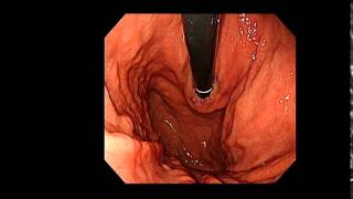 Esophagogastroduodenoscopy demonstration [upl. by Annairdna298]