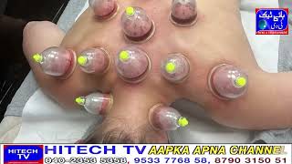 Hijama Tambako Noshi Se Nijat Ka Muasar Ilaj [upl. by Wrightson101]