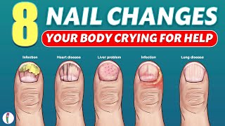 Nail signs of Disease  Nail pitting  Finger clubbing  Signs of anemia  Terrys nails [upl. by Yevrah]