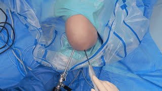 ApolloRF® SJ50 Probe for Meniscal and Chondroplasty Procedures [upl. by Erminie]