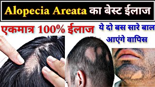 Alopecia Areata का बेस्ट ईलाज  Allopathic treatment of Alopecia Areata  Hair fall [upl. by Lud]