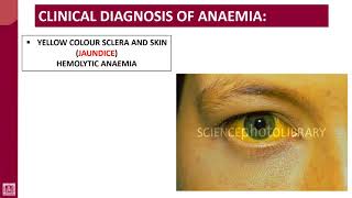 Hematology  1  U5L7  Clinical diagnosis of anaemia [upl. by Ateekan]