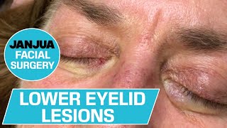 LOWER EYELID LESIONS  DR TANVEER JANJUA  NEW JERSEY [upl. by Yde]