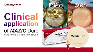 Clinical application of MAZIC DuroDr Bae [upl. by Neibaf698]