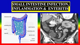 SMALL INTESTINE INFECTION INFLAMMATION amp ENTERITIS  Define  causes  types signs  diagnostic [upl. by Eberto387]