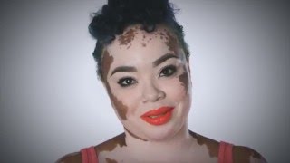 Vitiligo Truth Hope and Change fulllength [upl. by Enelhtac]