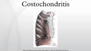 Costochondritis [upl. by Cohla]