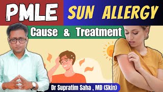 Most common sunlight induced skin rash  PMLE  Treatment [upl. by Coffee850]