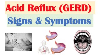 Gastroesophageal Reflux Disease GERD Signs amp Symptoms ex Bad Teeth  amp Why They Occur [upl. by Siward]