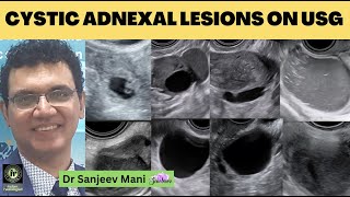 USG Pelvis  Cystic Adnexal Lesions On Ultrasound  SANJEEV MANI  Endometriosis  Ovarian Dermoid [upl. by Salema652]