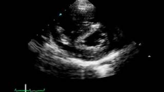 A 17YearOld Girl with Chest Pain and Hemoptysis [upl. by Nnaacissej270]