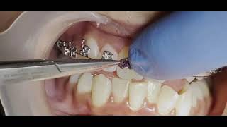 CLASS 1 MALOCCLUSION with anterior teeth crowding  IPR  Braces  orthodontics [upl. by Sprague]