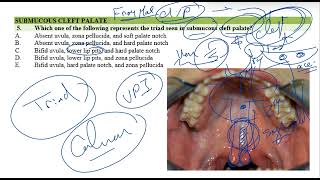 Submucous Cleft Palate [upl. by Flita]