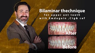 Bilaminar thechnique for upper ant teeth with Emdogain Ctgamp caf  Dr Amirreza Moayer [upl. by Schweiker]