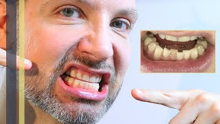 ZÄHNE WIEDER SCHIEF – NUR 2 JAHRE NACH DR SMILE  INVISALIGN ZAHNKORREKTUR – GREY YOUNG [upl. by Ahron]