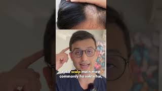 What is Alopecia Areata  Alopecia Areata kya hota hai  Dr Ankur Sarin [upl. by Tarton]