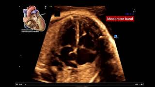 2022 Fetal Echocardiography Normal and Abnormal Hearts  A Video CME Teaching Activity [upl. by Grane]