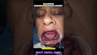 Fix teeth in 5 days ytshorts dental implantsurgery maxillofacialsurgeon [upl. by Yatzeck]