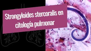 Strongyloides stercoralis en citología pulmonar [upl. by Lais]