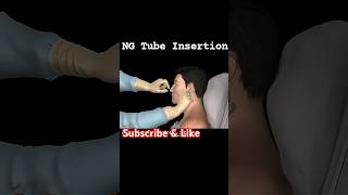 ng tube insertion procedure  ng tube foryou shorts [upl. by Assille]