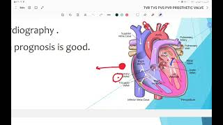 valvular heart disease [upl. by Laird105]