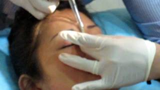 Fillers injection for sharper nose bridge [upl. by September]