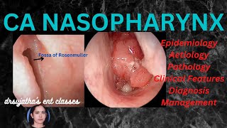 199Nasopharyngeal Carcinoma Part 13 epidemiology aetiologyclinical features nasopharynx [upl. by Airdnna]