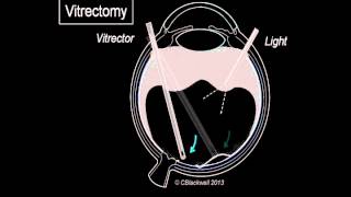 Vitreous 3 Vitrectomy Surgery [upl. by Selassie]