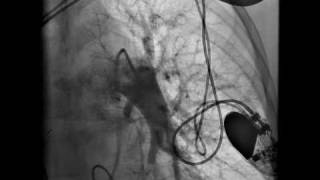 Pulmonary embolism Part 2 [upl. by Joshia]