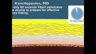 Prophylactic collagen crosslinking for highrisk LASIK  Video abstract 31256 [upl. by Lasser]