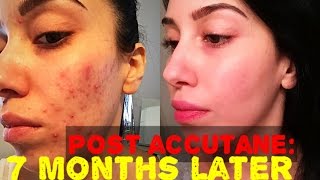 Accutane Journey  7 MONTHS POST  Skin Update amp LONG TERM Side Effects [upl. by Phaedra446]