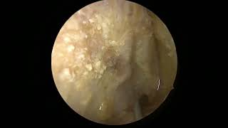 Transorbital approach to middle cranial fossa and cavernous sinus [upl. by Seravaj811]