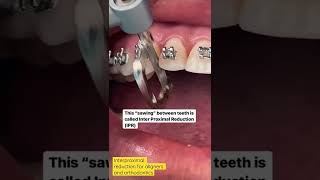 What is Interproximal reduction  Why and how  IPR orthdontics aligners [upl. by Deva791]