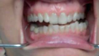 TMJ and Bite Treatment [upl. by Eramat]